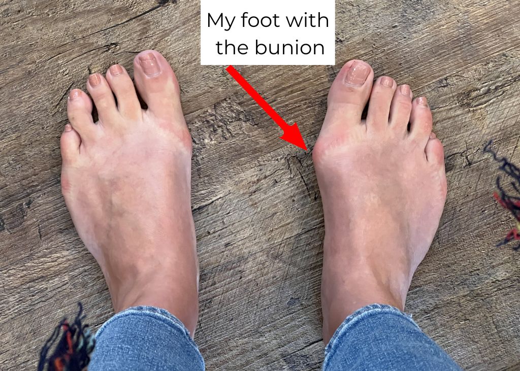 My foot with the bunion